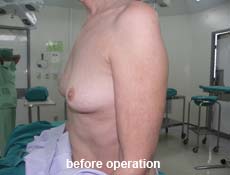 plastic-surgery-breast-augmentation 